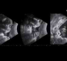31 Tjedana trudna - Ultrazvuk standardi