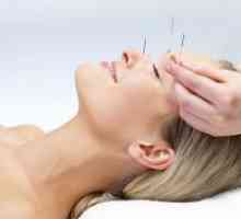 Akupunktura za mršavljenje