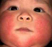 Atopijski dermatitis u djece