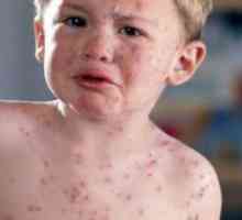 Alergičan na slatko dijete