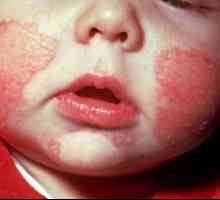 Alergija kod beba - što je nesreća?