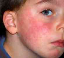 Alergije kod djece - kako liječiti?