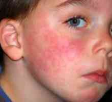 Simptomi alergije kod djece