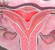 Anomalije maternice