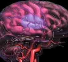 Cerebralna ateroskleroza - Simptomi