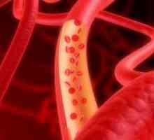 Arterioskleroza