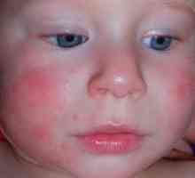 Atopijski dermatitis u djece - liječenje