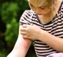Kako liječiti komarac ugrize dijete?