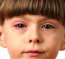 U isprati oči konjunktivitisa u djece?