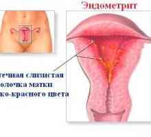 Što je endometrioza?