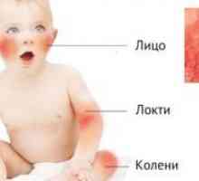 Dermatitis u djece