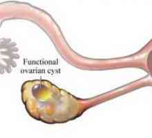 Dermoidna cista jajnika