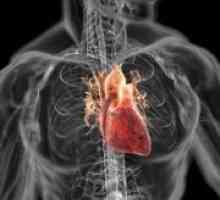 Dilatacijske kardiomiopatije