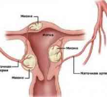Fibroidi maternice