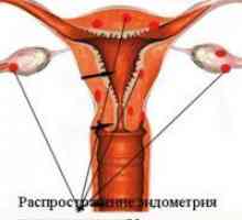 Genitalija endometrioza