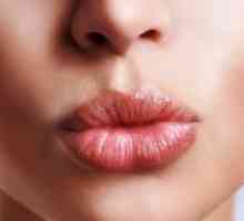 Herpes na usnama - brzi tretman