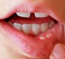 Herpes u ustima djeteta