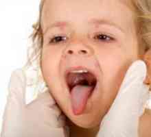 Herpangina u djece - liječenje