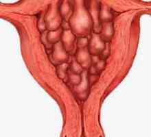 Hiperplazija endometrija - što je to?