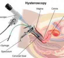 Histeroskopija - posljedice