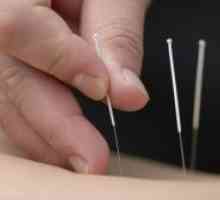 Akupunktura u osteochondrosis