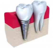 Dentalni implantati - kontraindikacije i moguće komplikacije