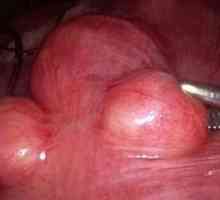 Međuprostorne subserous fibroidi maternice