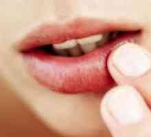 Čireve u ustima - liječenje