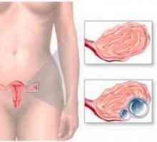 Endometrioid jajnika cista - liječenje