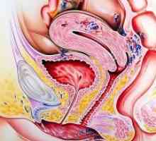 Crijevna Endometrioza - Simptomi
