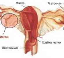 Korpusa uterusa Endometrioza