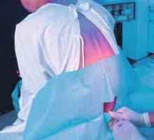 Epiduralne anestezije tijekom porođaja