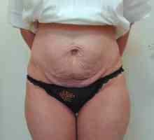Kako ukloniti trbuh masnoće nakon poroda?