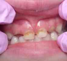 Karijes mliječnih zubi