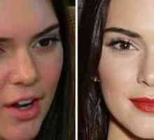 Kendall Jenner prije i nakon plastične