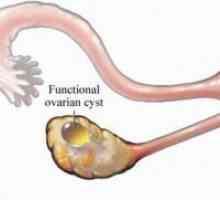 Lijevo jajnika cista - Simptomi