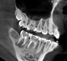 Kompjuterizirana tomografija zubi