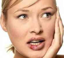 Liječenje herpesa na usnama: brzo, efikasno i jeftino