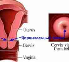 Liječenje kronične cervicitis