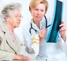 Liječenje osteoporoze u starijih žena