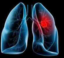 Liječenje raka pluća narodnih lijekova