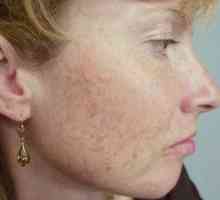 Ožiljak tretman akni na licu