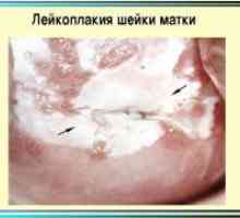 Cervikalna leukoplakija - Simptomi