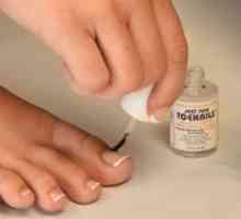 Najbolji lijek za noktiju gljiva na nogama