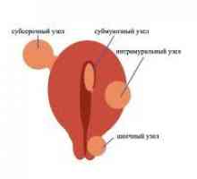 Uterine fibroids - uzroci