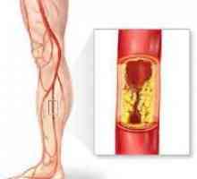 Povreda donjih udova cirkulacije - Simptomi