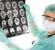 Tumor na mozgu - simptomi u ranim fazama
