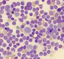 Akutna limfoblastična leukemija