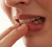 Parodontitis - liječenje