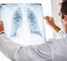 Pneumotoraks pluća